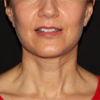 61 year old woman treated with Facelift 5 weeks post-op after 3419008