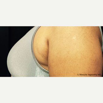 "Side-Bra" Fat Reduction with Kybella before 2485972