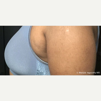 "Side-Bra" Fat Reduction with Kybella after 2485972