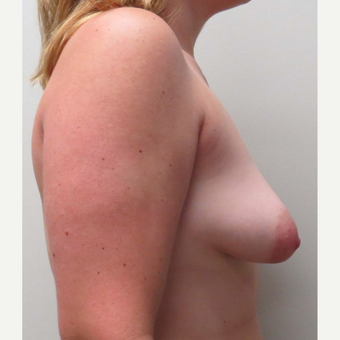 Breast Lift with Implants for this 24 Year Old Woman before 3289548