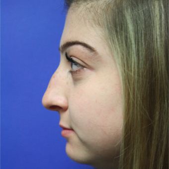 18-24 year old woman treated with Rhinoplasty before 3400169