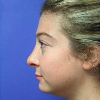 18-24 year old woman treated with Rhinoplasty after 3400169