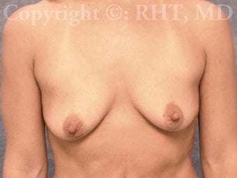 33 yo mother of two with post-pregnancy breast droop and loss of volume. 1169152