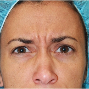 41 year old female treated with Botox for frown lines before 3071472