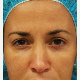 41 year old female treated with Botox for frown lines after 3071472