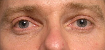 Restylane upper eyelid hollows after 219711