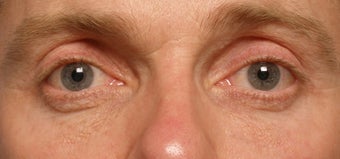 Restylane upper eyelid hollows before 219711