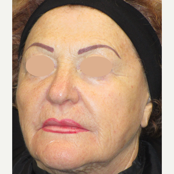 65-74 year old woman treated with Laser Surgery before 3090112