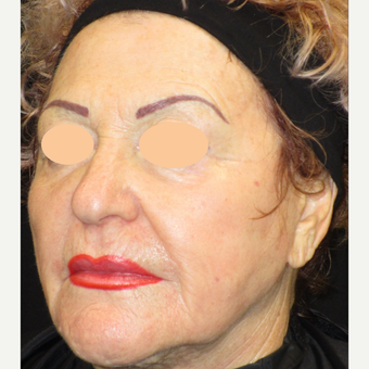 65-74 year old woman treated with Laser Surgery after 3090112