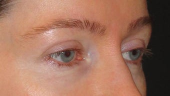 Botox 967782