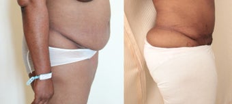 35-44 year old woman treated with Panniculectomy before 2118011