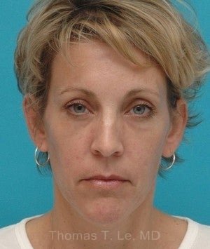 Browlift, upper blepharoplasty, lower blepharoplasty after 341615