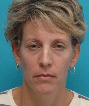 Browlift, upper blepharoplasty, lower blepharoplasty before 341615