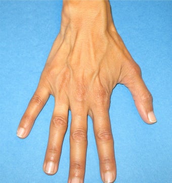 Hand Rejuvenation before 106450