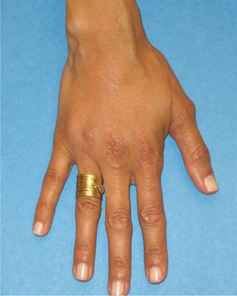 Hand Rejuvenation after 106450