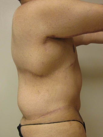 28 year old male who underwent extended abdominoplasty (tummy tuck) 1422632