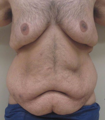 28 year old male who underwent extended abdominoplasty (tummy tuck) before 1422632