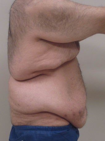 28 year old male who underwent extended abdominoplasty (tummy tuck) 1422632