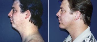 Chin Augmentation before 997230