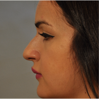 18-24 year old woman treated with Rhinoplasty before 3332883