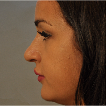 18-24 year old woman treated with Rhinoplasty after 3332883