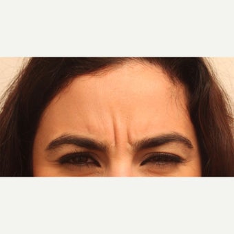 35-44 year old woman treated with ThermiRase for the frown lines before 2359342