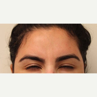 35-44 year old woman treated with ThermiRase for the frown lines after 2359342