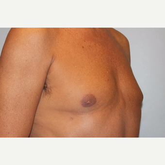 55-64 year old man treated with Male Breast Reduction after 3569494