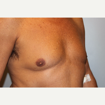55-64 year old man treated with Male Breast Reduction before 3569494