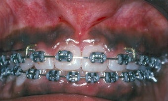 Gum Depigmentation Before and After before 957140