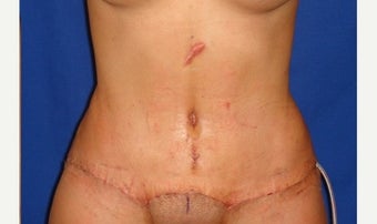 25-34 year old woman treated with Tummy Tuck Revision after 2289335