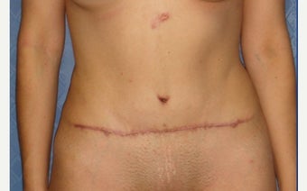 25-34 year old woman treated with Tummy Tuck Revision before 2289335