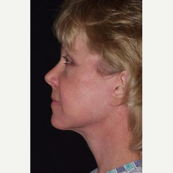 52 year old seeking more youthful appearance after 3481150