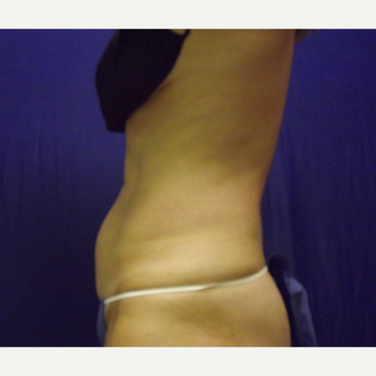 52 year old female's abdomen treated with 1 SculpSure treatment after 2814904