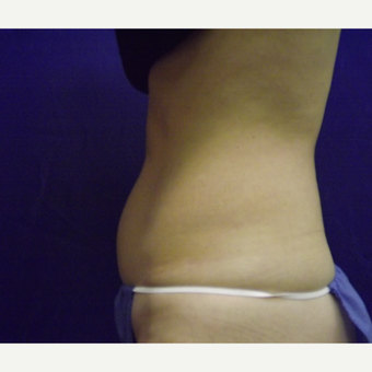 52 year old female's abdomen treated with 1 SculpSure treatment before 2814904