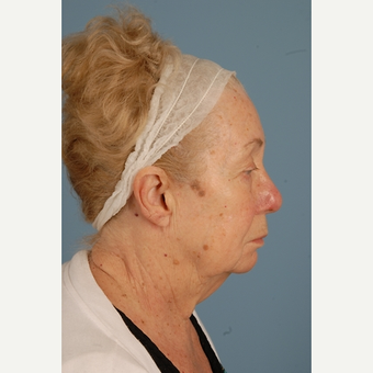 75 year old woman treated with Facelift before 3839659