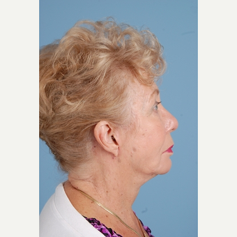 75 year old woman treated with Facelift after 3839659