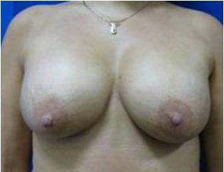 49 year old woman treated with Breast Lift with Implants after 3726842
