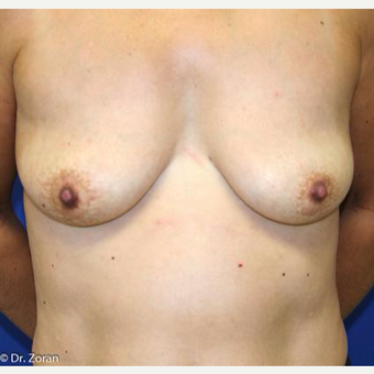 45-54 year old woman treated with Breast Lift before 3037387