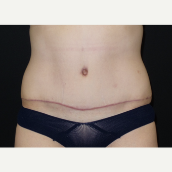 25-34 year old woman treated with Tummy Tuck after 3094375