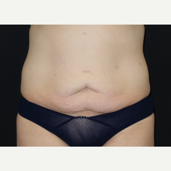 25-34 year old woman treated with Tummy Tuck before 3094375
