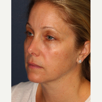35-44 year old woman treated with IPL before 3137033