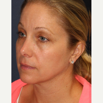 35-44 year old woman treated with IPL after 3137033