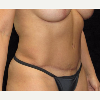 40 year old woman treated with Tummy Tuck after 3025927