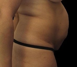 40 year old woman treated with Tummy Tuck 3025927