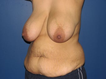 35 year old mother of four with a mommy makeover 1002562