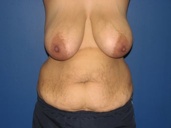 35 year old mother of four with a mommy makeover before 1002562