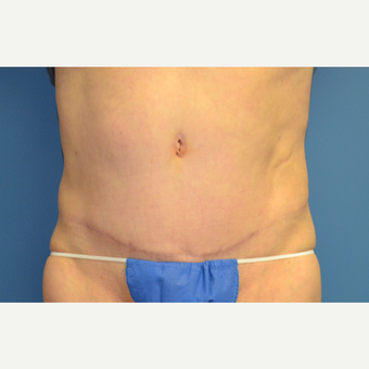 45-54 year old woman treated with Tummy Tuck after 3258723