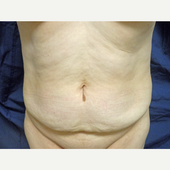 45-54 year old woman treated with Tummy Tuck before 3258723