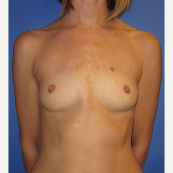 35-44 year old woman treated with Breast Augmentation (371cc) before 2844459